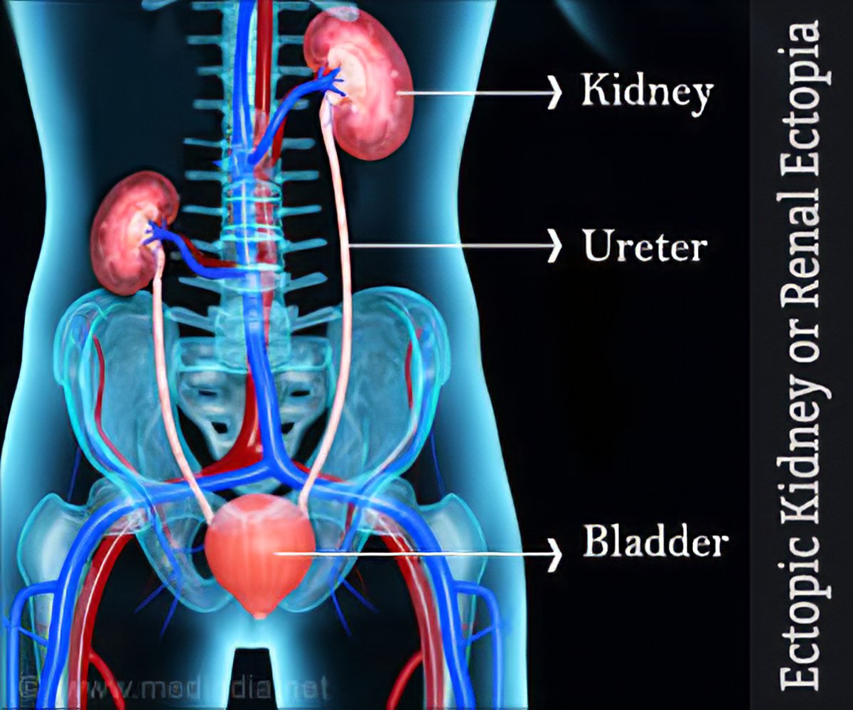 What is the medical term meaning dilated renal pelvis