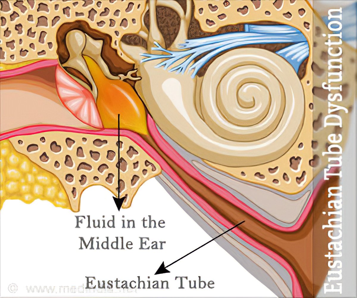 Eustachian Tube Dysfunction - Causes, Symptoms, Diagnosis, Treatment