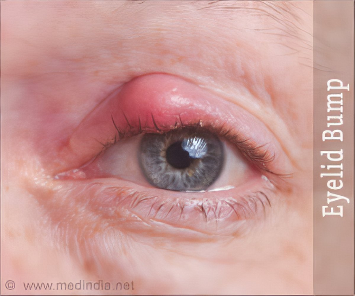 Bump on Eyeball: Causes, Symptoms, and Treatment