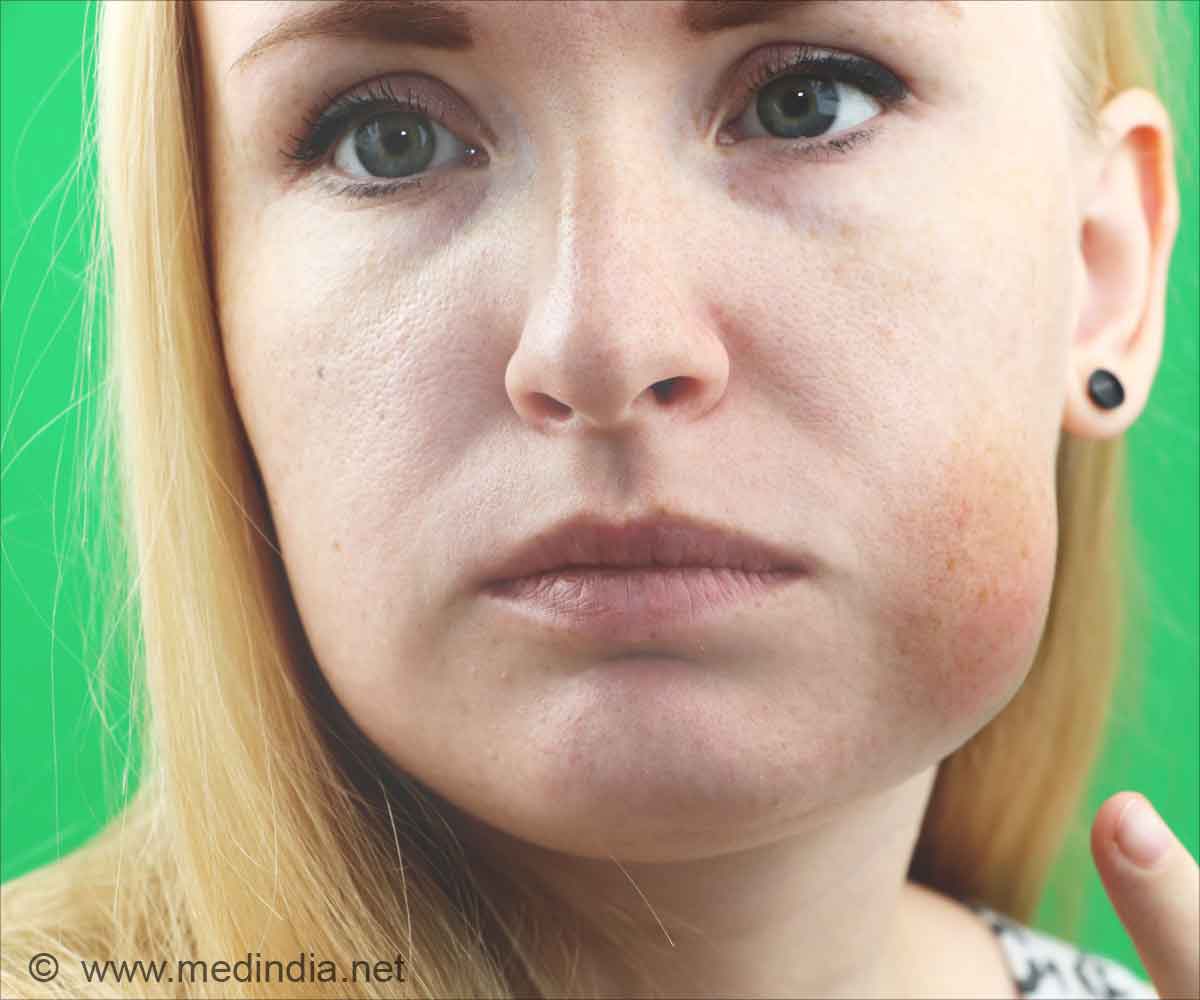 Ways To Reduce Swelling From Facial Cellulitis AskDocs