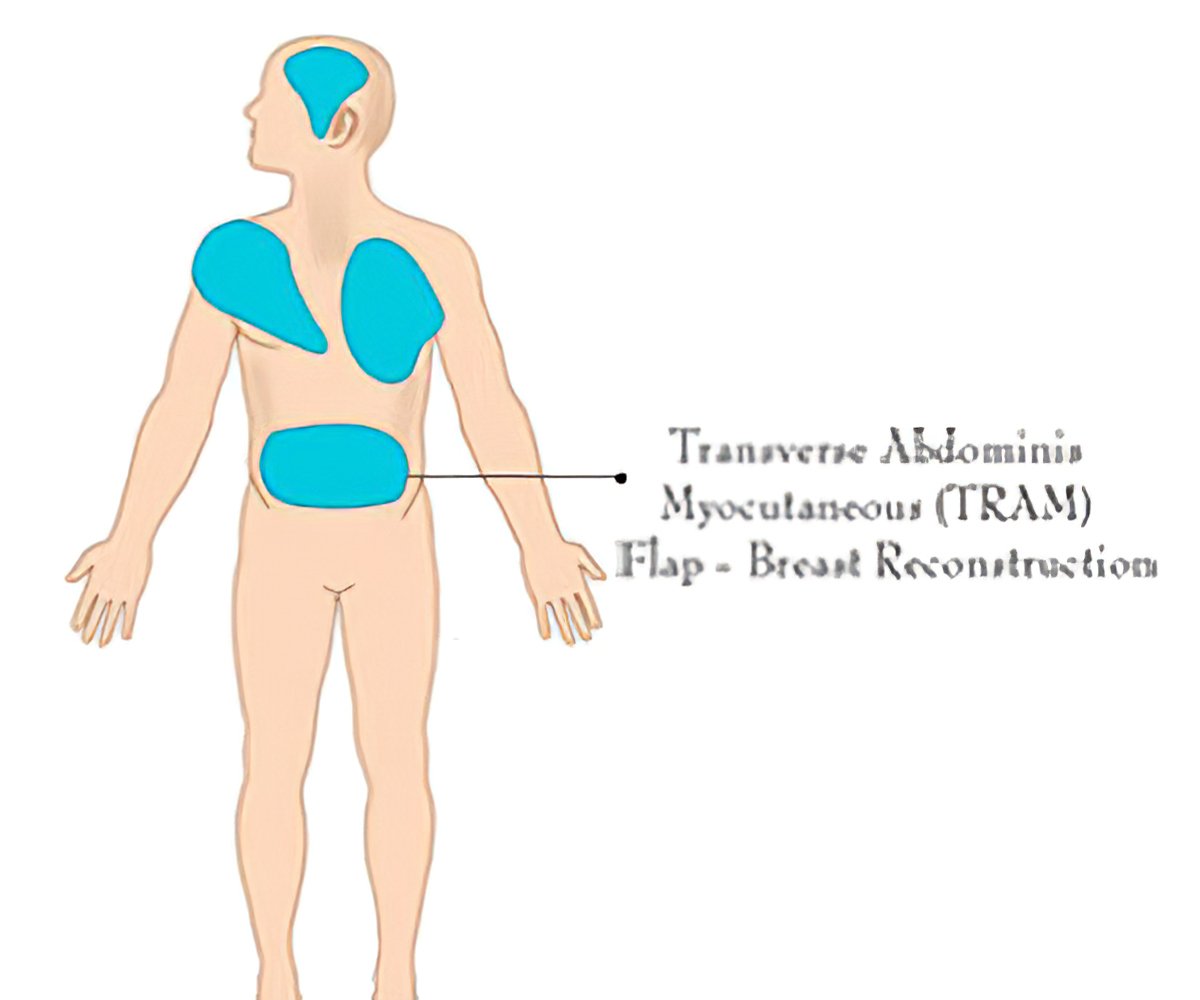 flap-surgery-types-tests-procedures-and-complications