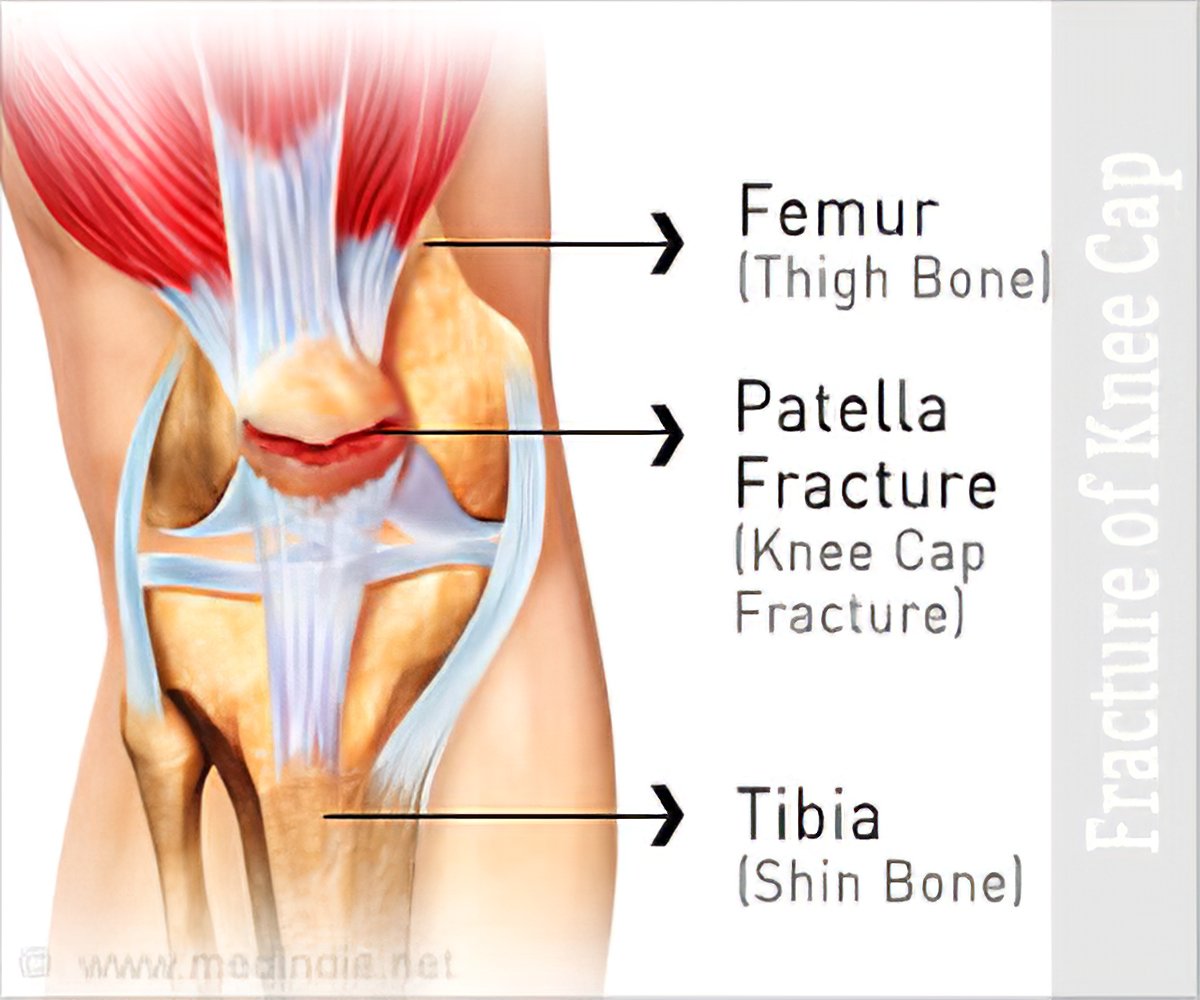 patella fracture