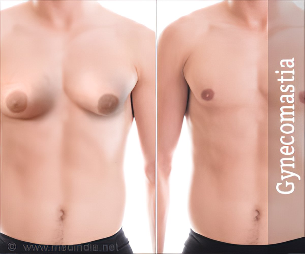 Gynecomastia Before & After Gallery
