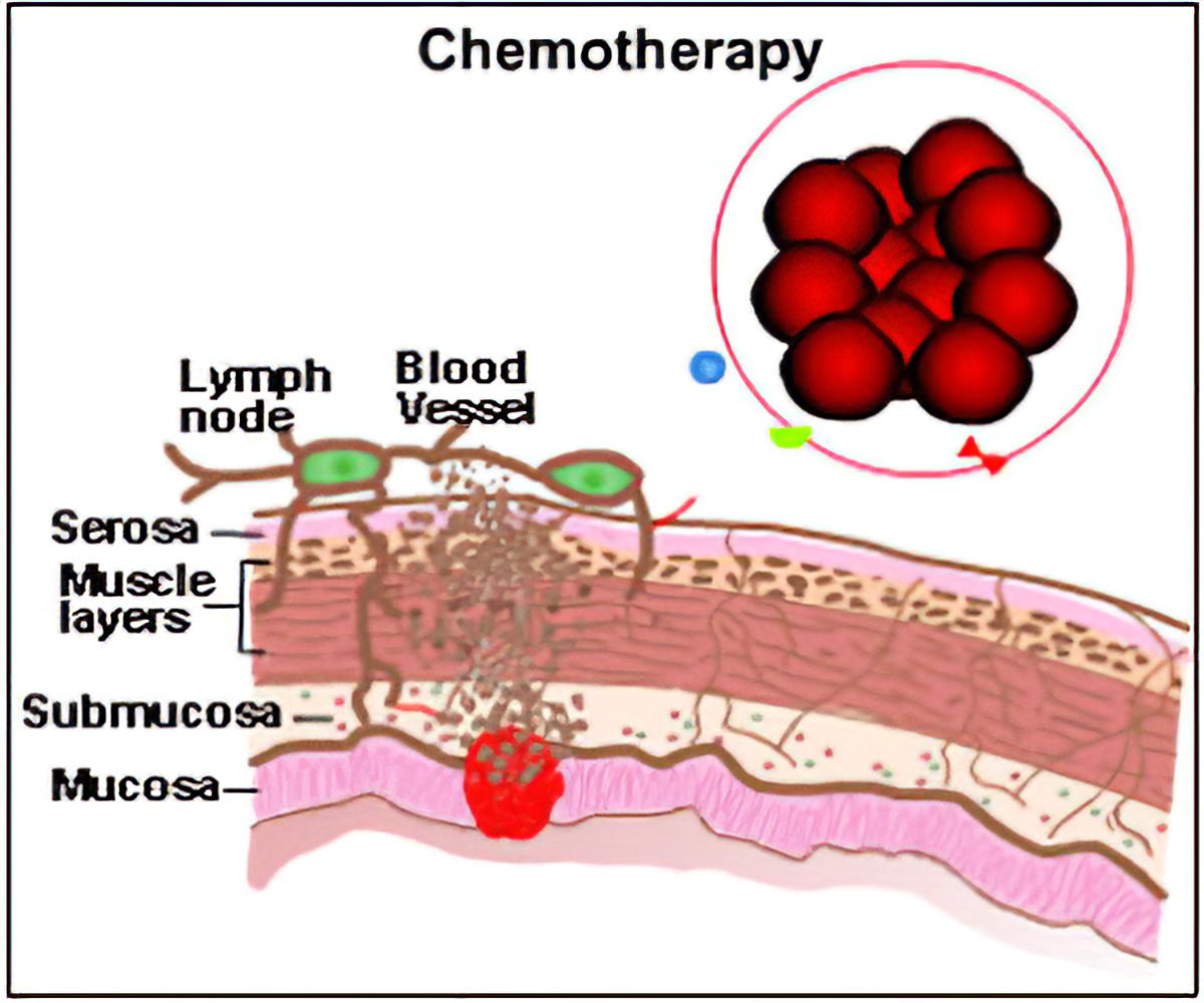 Chemotherapy - Pros and Cons