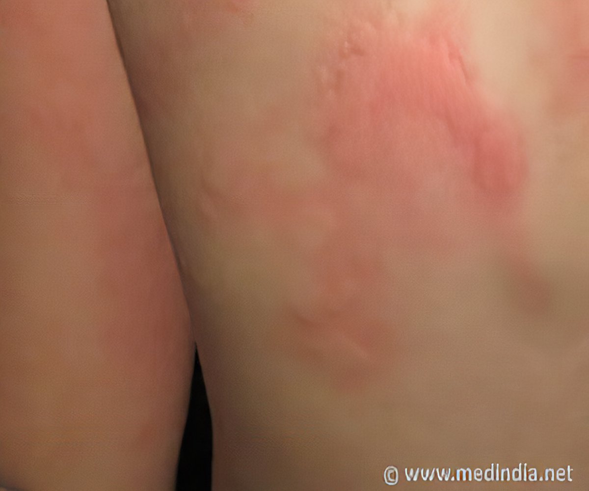 Hives / Urticaria - Symptom Evaluation