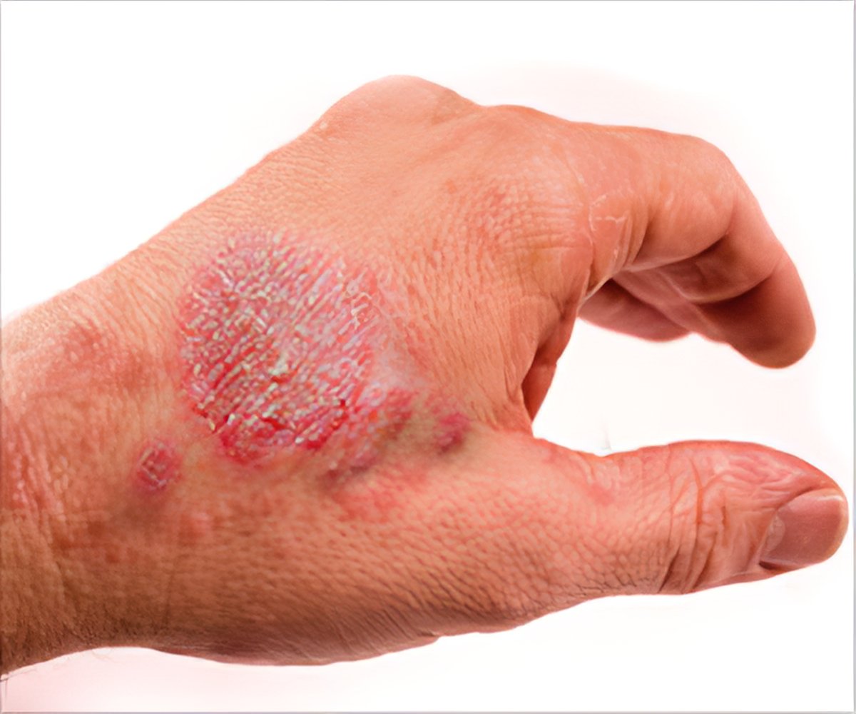 Eczema: Miracles with Homeopathy