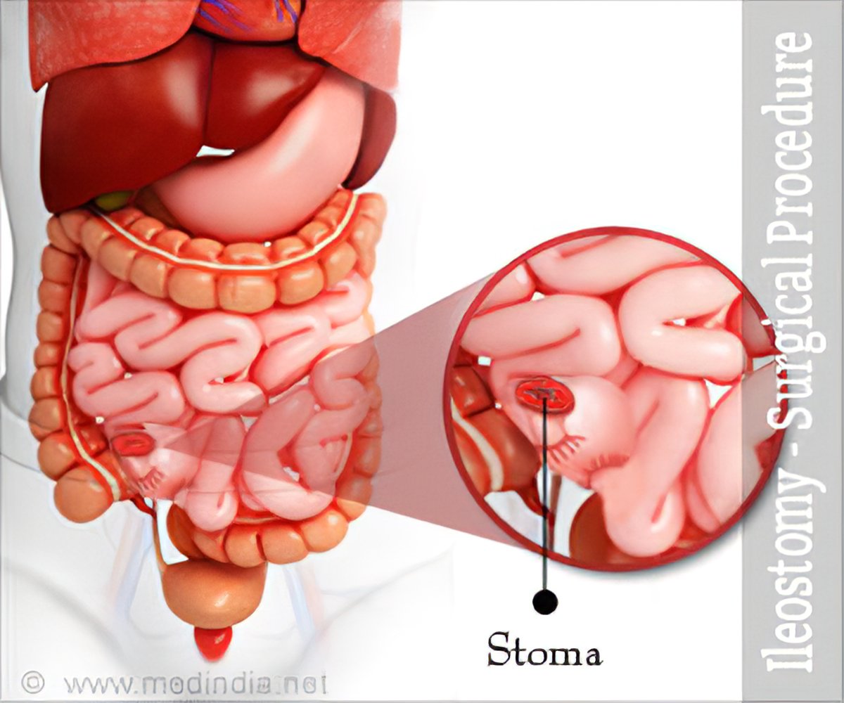 Ileostomy Surgery