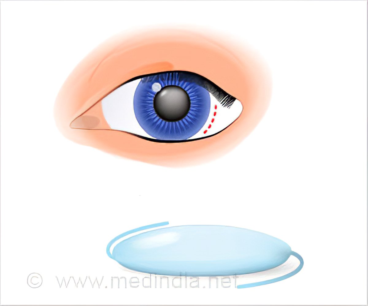 Intraocular Lens Implants (IOL) - Types, Procedure, Recovery & Complications