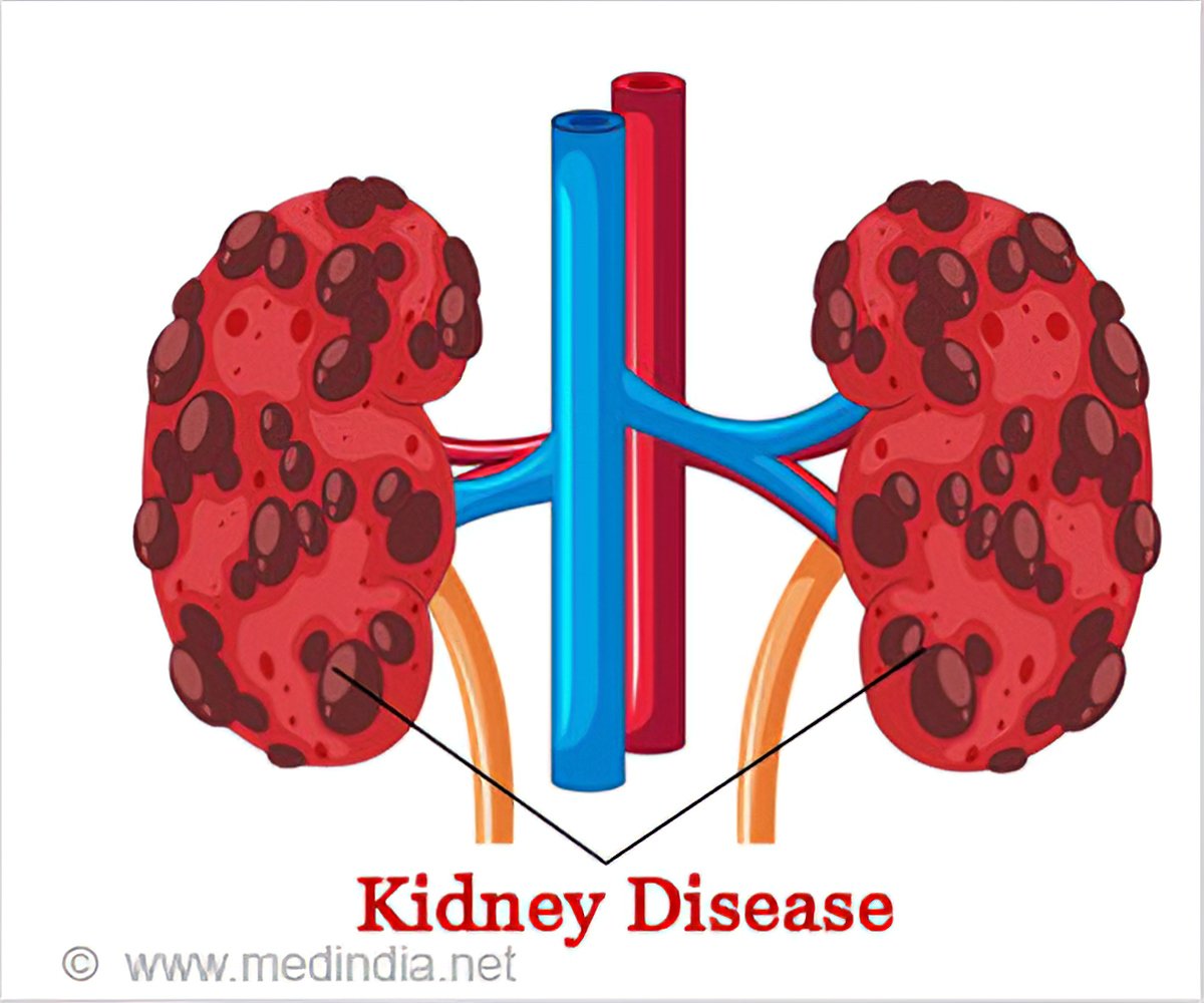 Prevention of Kidney Disease - Causes & Prevention