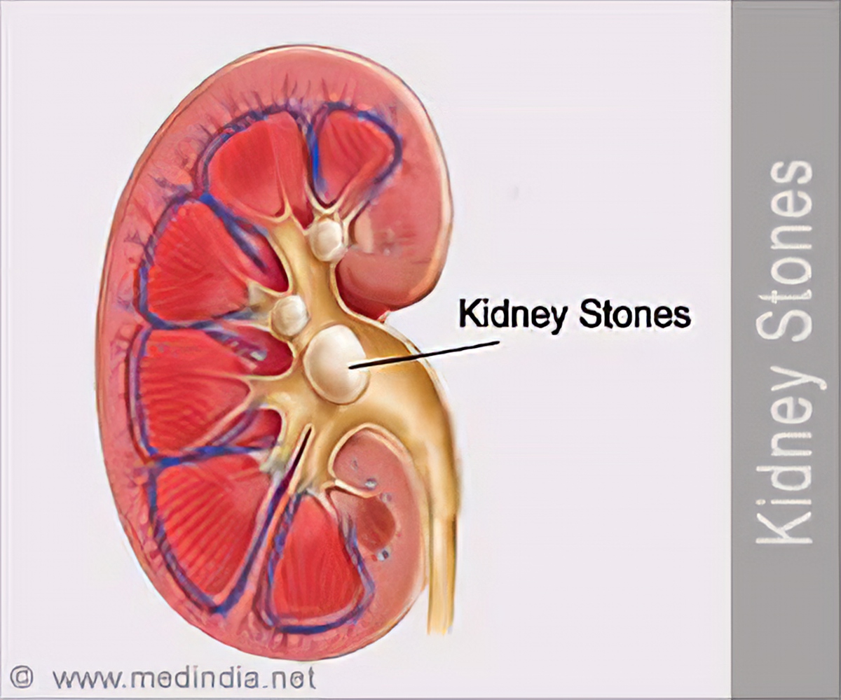 ivcd 10 for hx of kidney stones