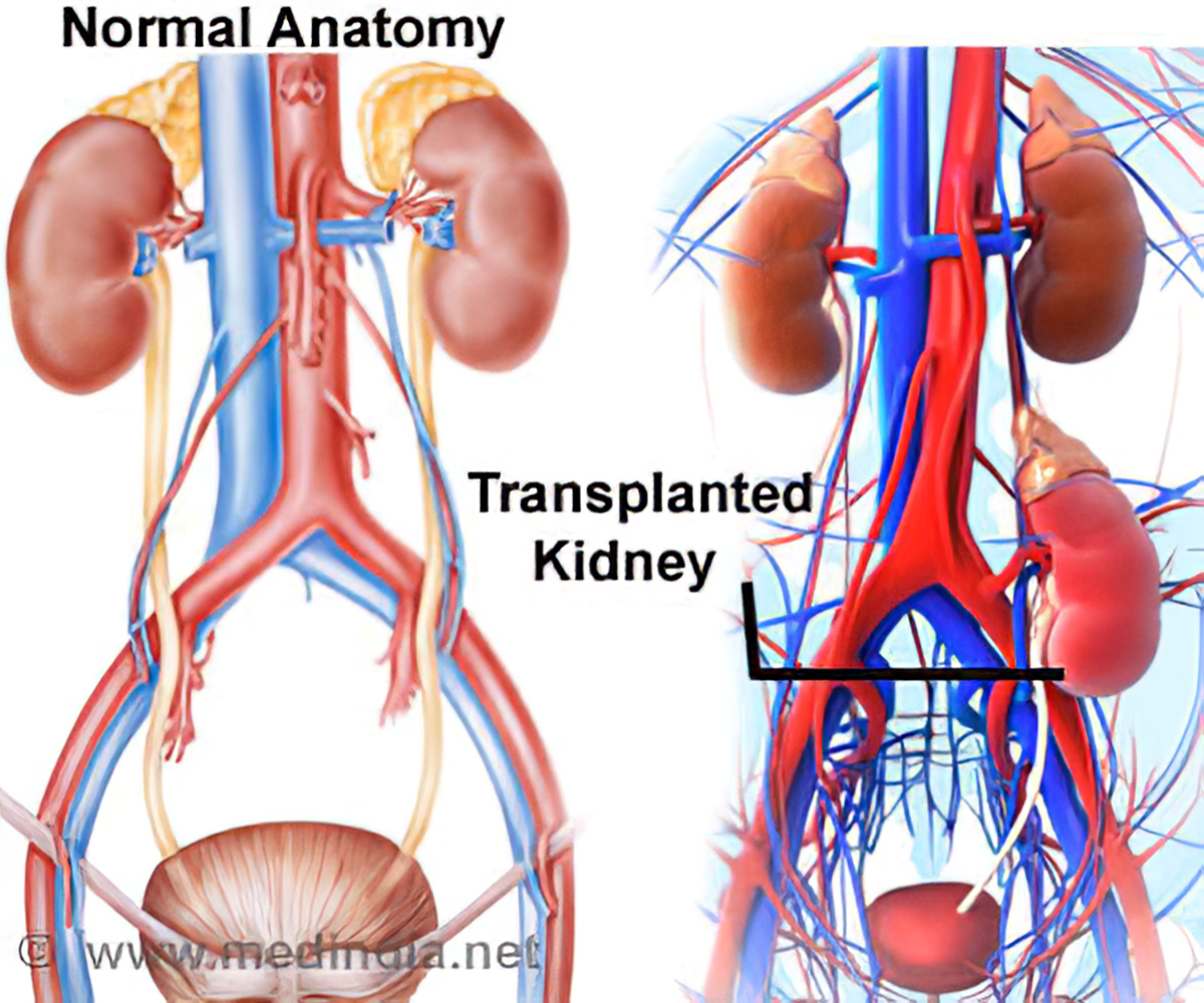 essay on kidney transplant