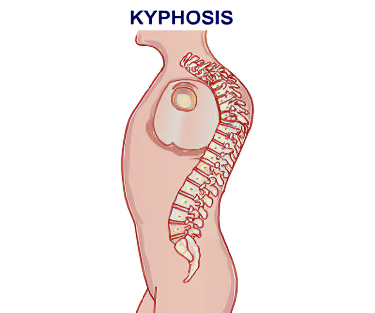Kyphosis - Diagnosis
کیفوز پشتی
