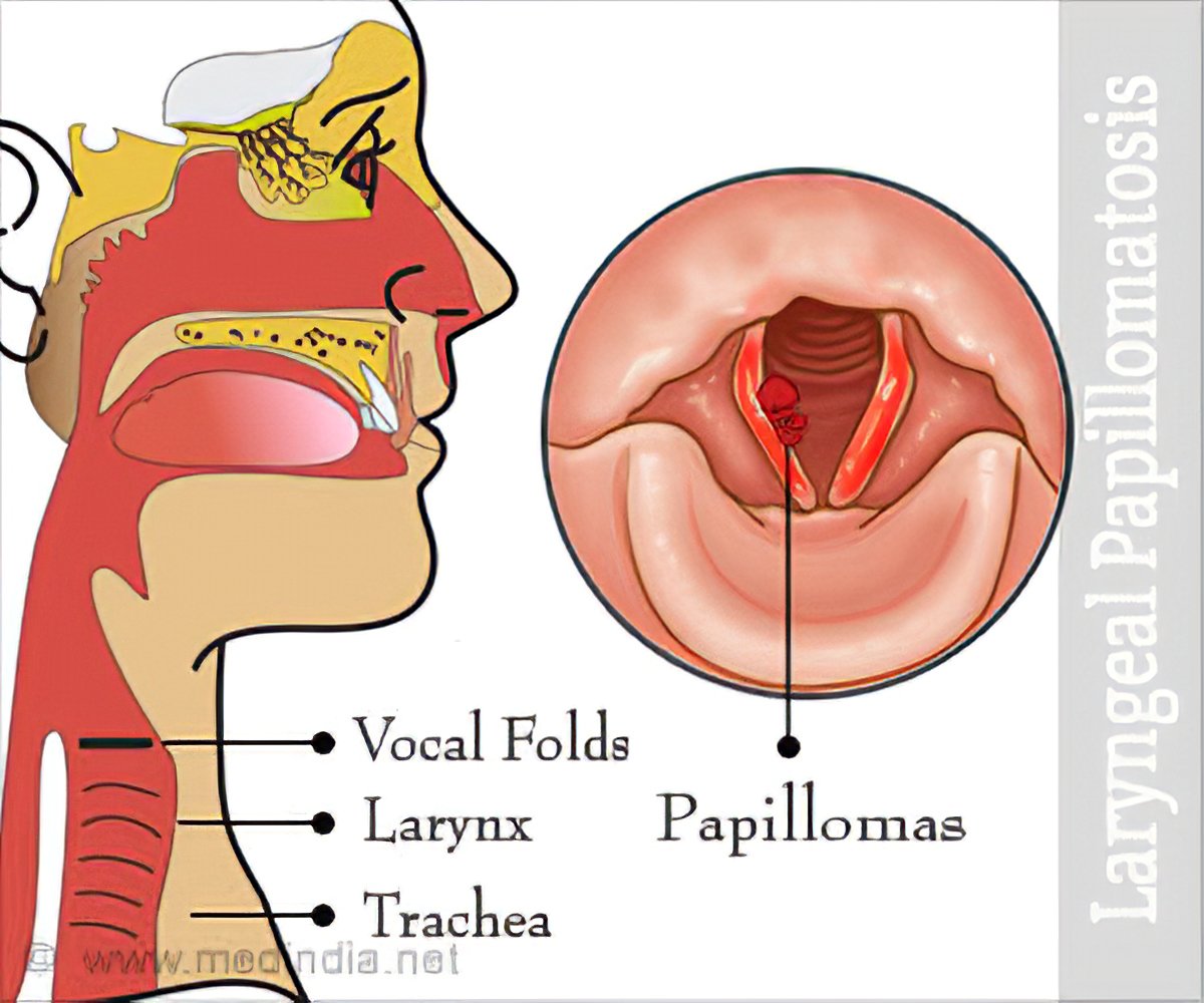 Respiratory tract papillomas, Respiratory tract papillomas