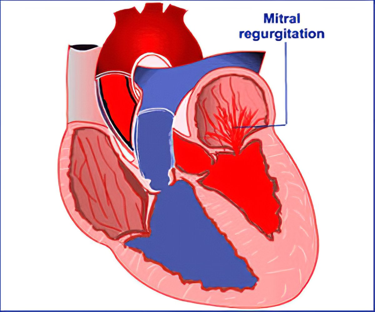 heart mitral valve regurgitation