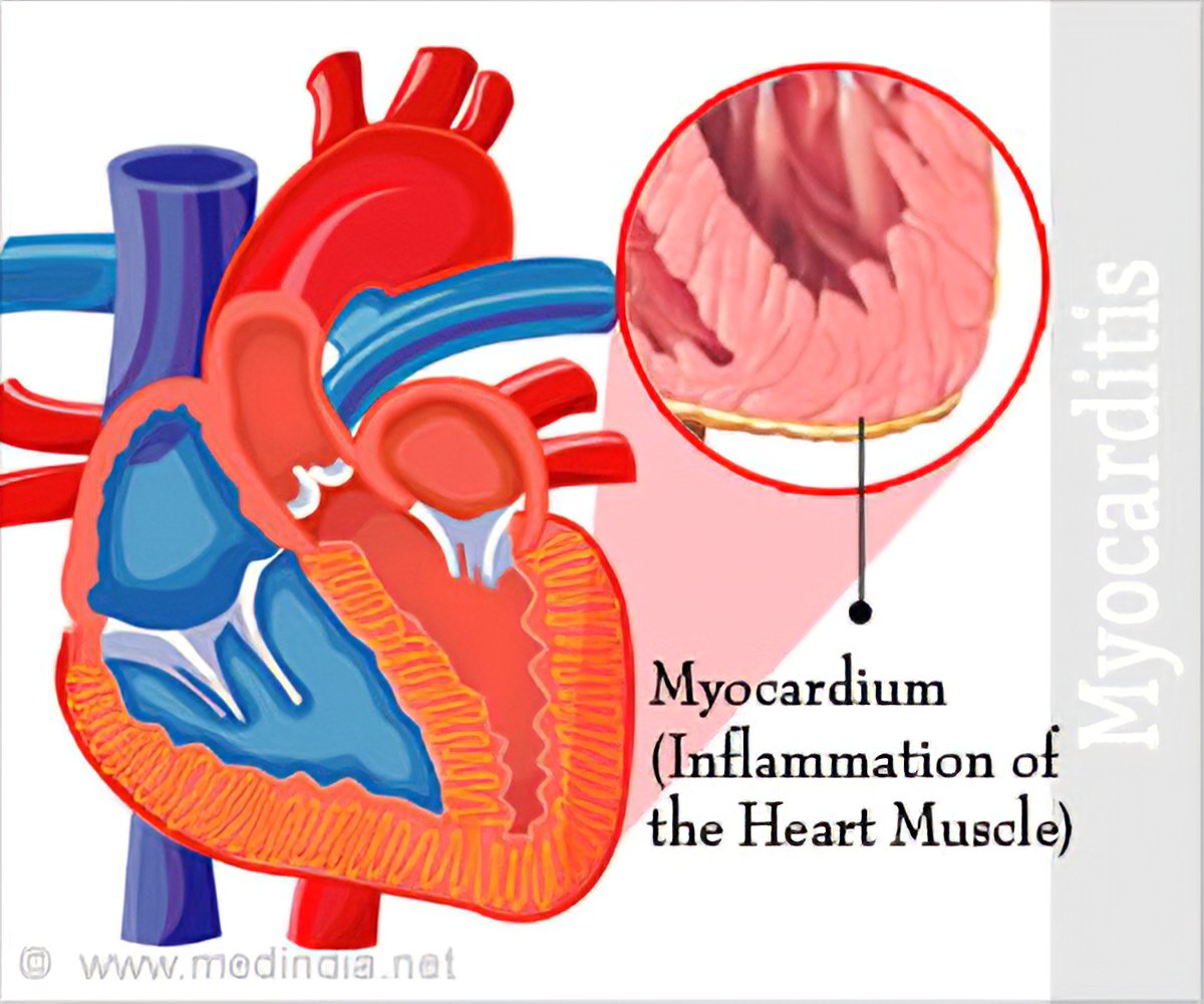 Myocarditis Heart Rate / Solved Myocarditis Heart Failure Questions ...