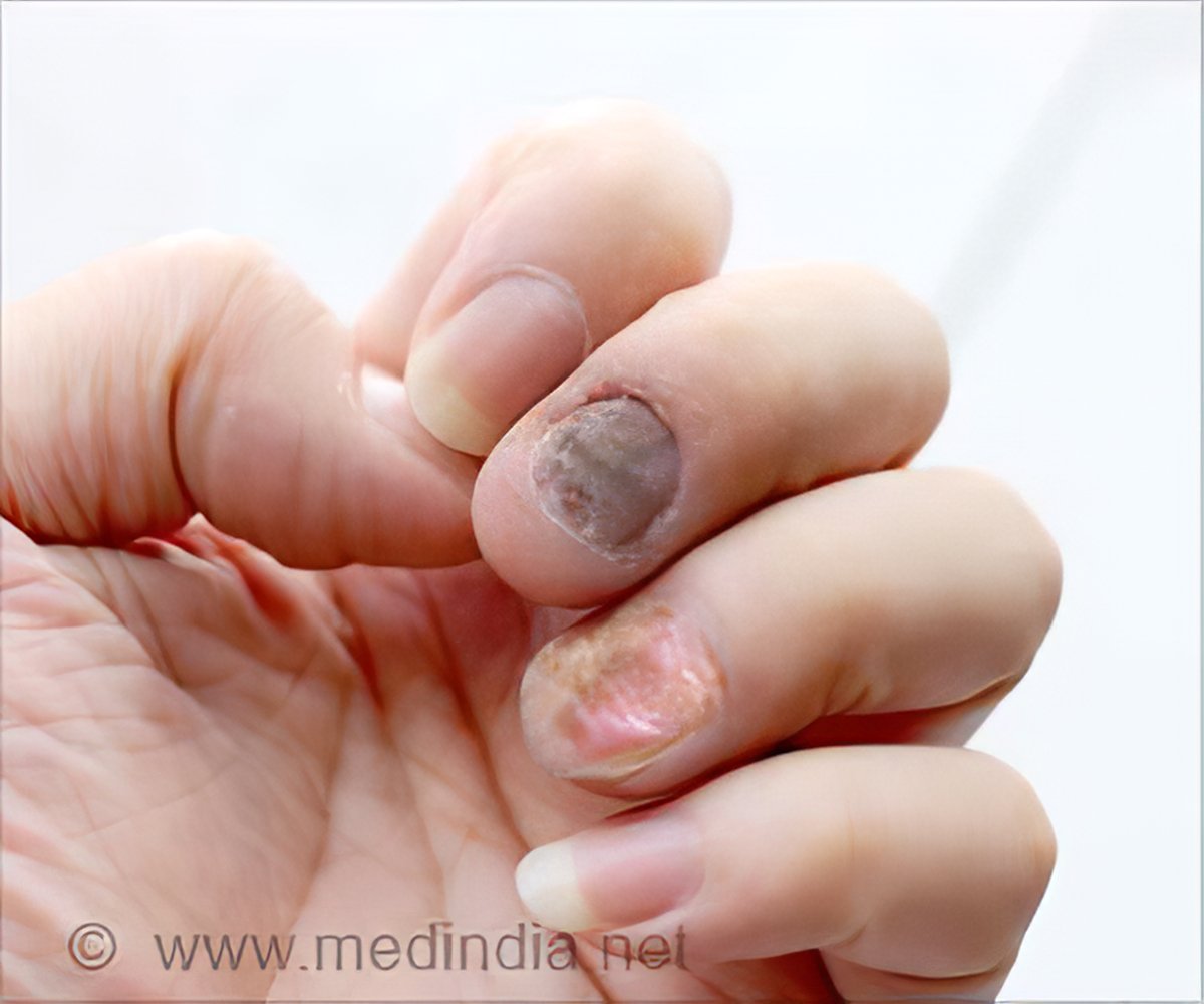 Psoriasis of the fingernails - Stock Image - C051/0056 - Science Photo  Library