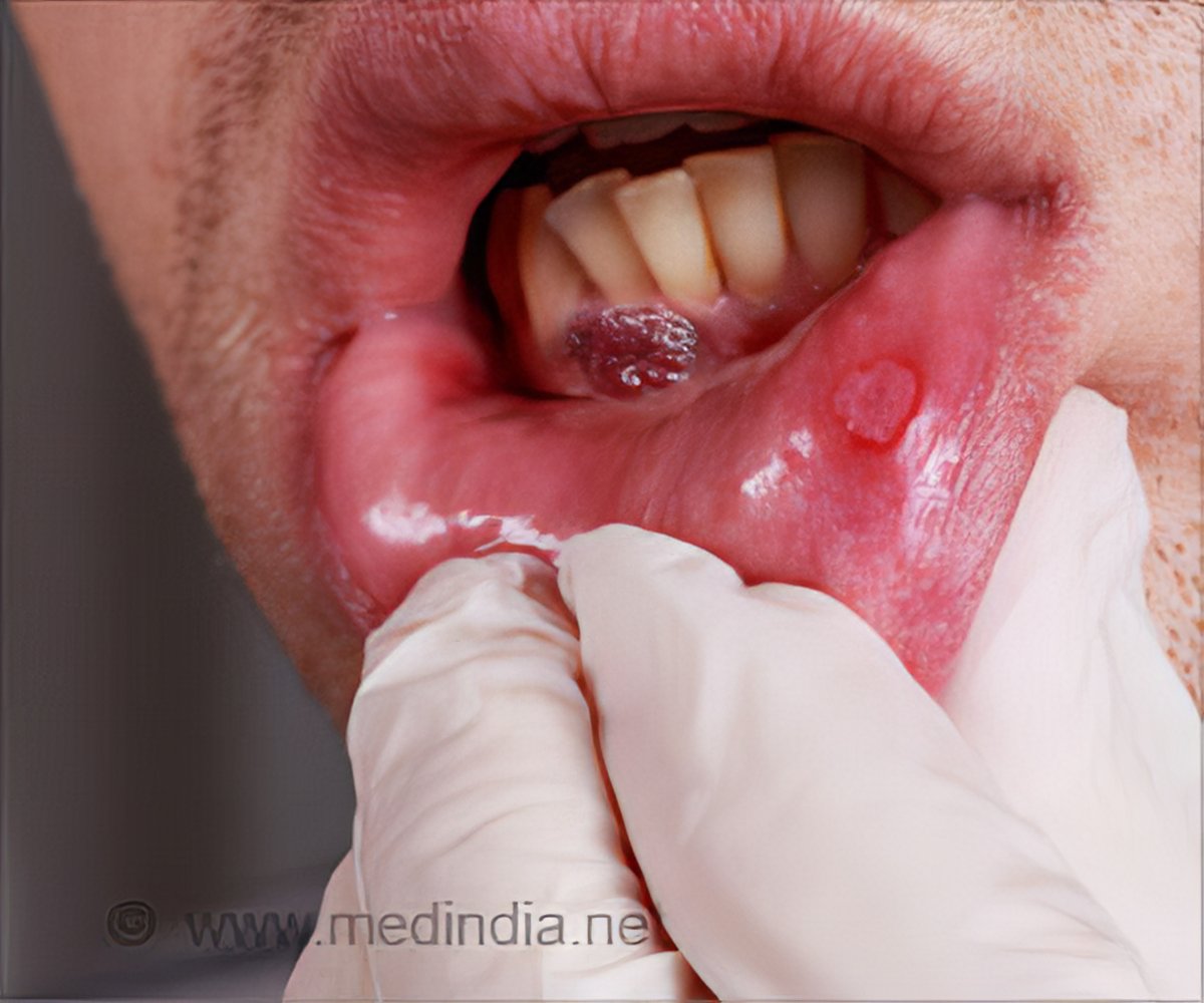 Oral Cancer Under Tongue