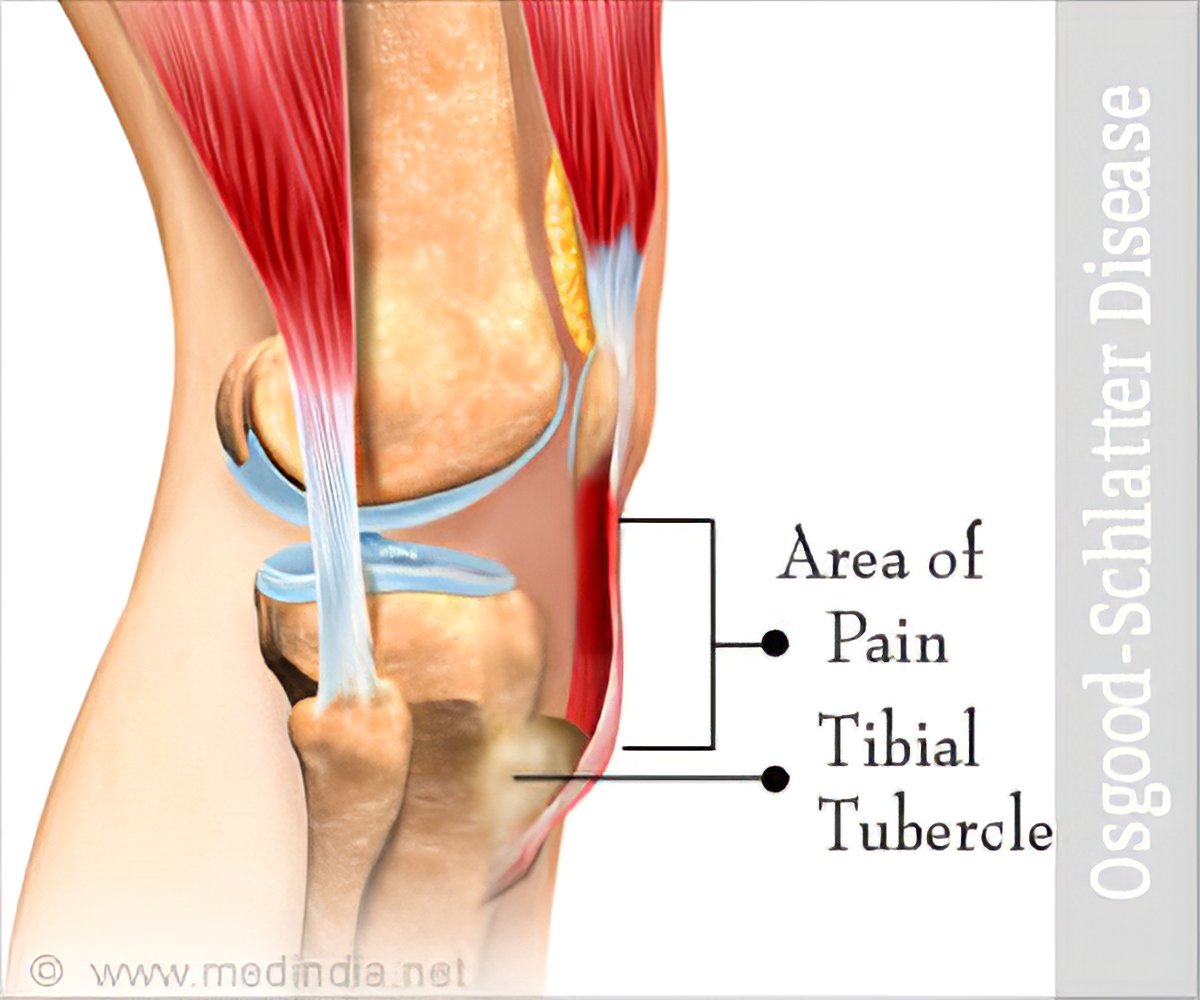 tibial-tuberosity-pain-hot-deal-save-53-jlcatj-gob-mx