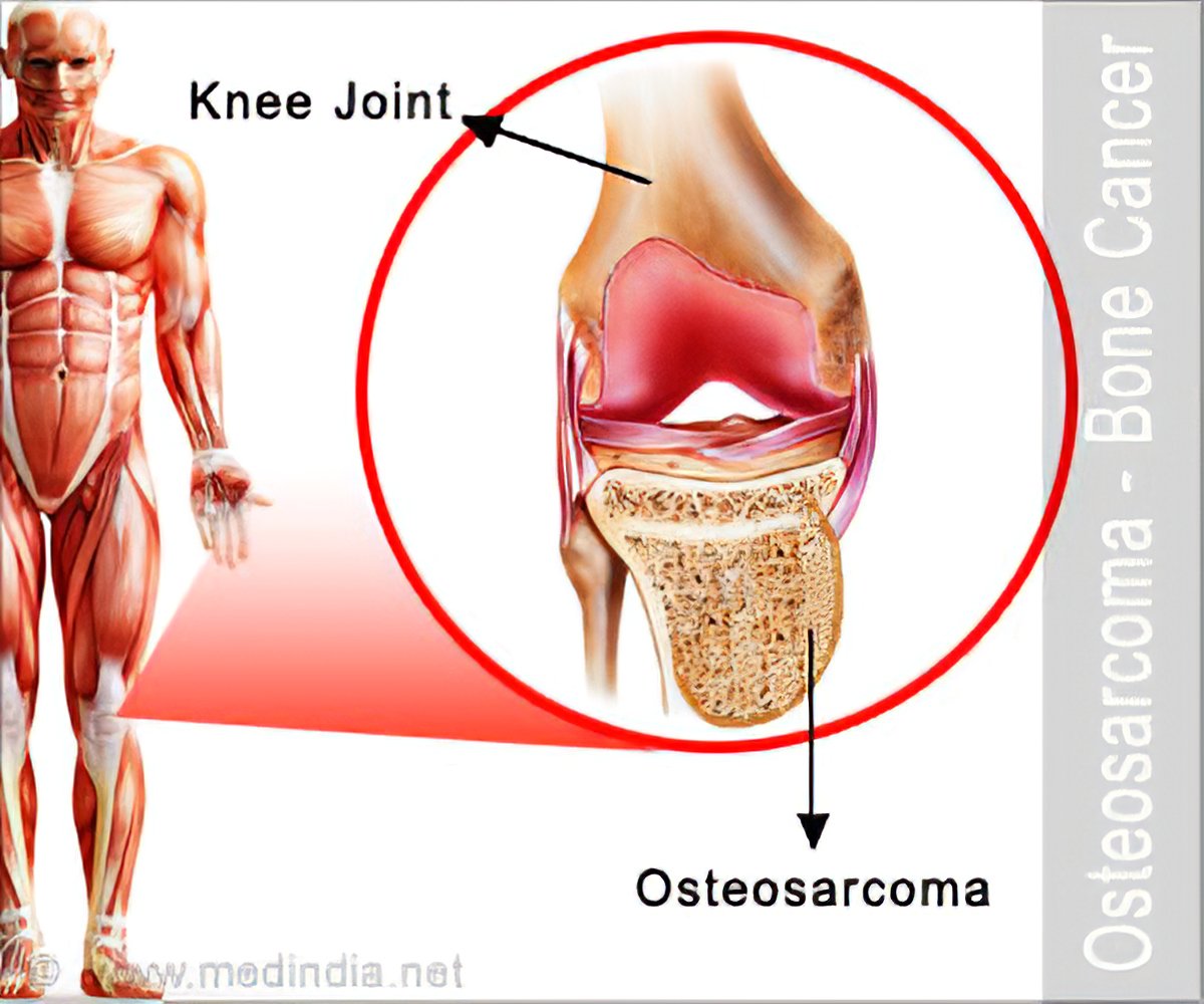osteosarcome