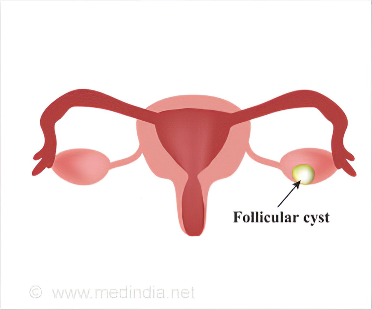 uterine cysts