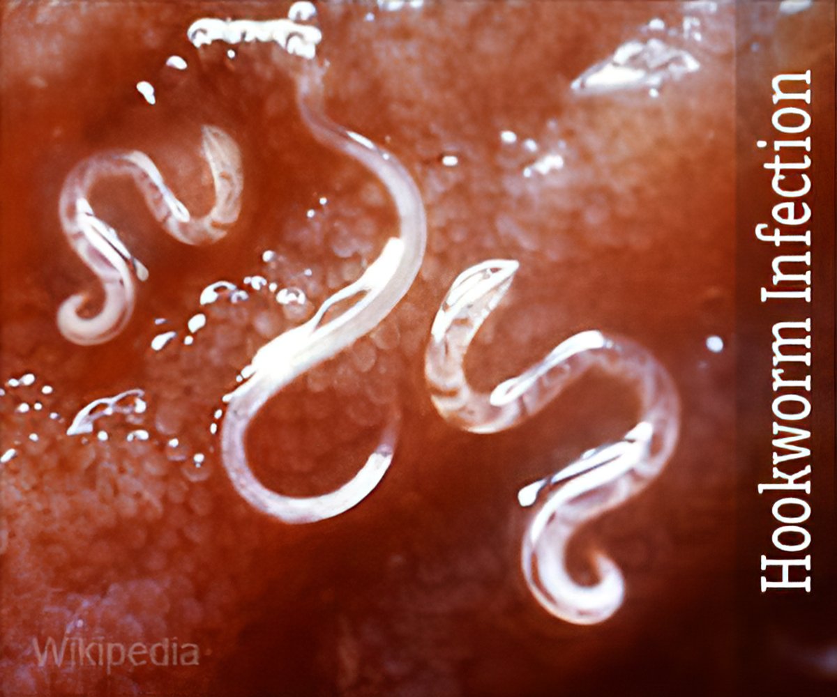 what are the signs of hookworms in humans