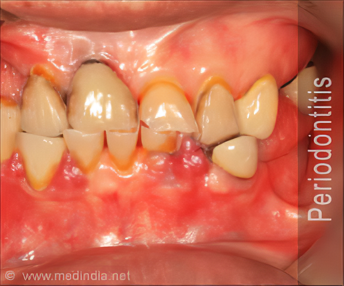 Periodontitis Treatment