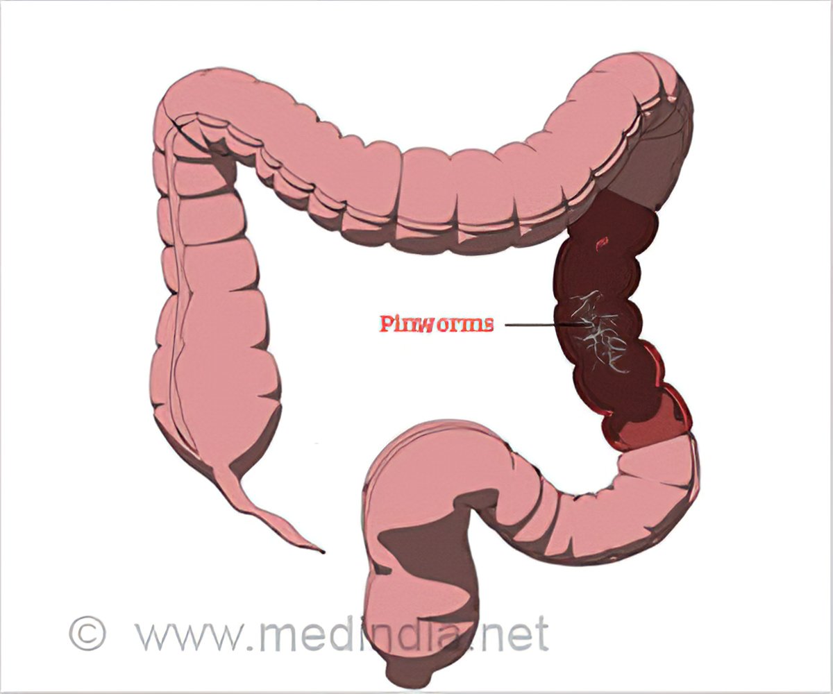 pinworm az enterobiasis paraziták kezelésére Surgutban