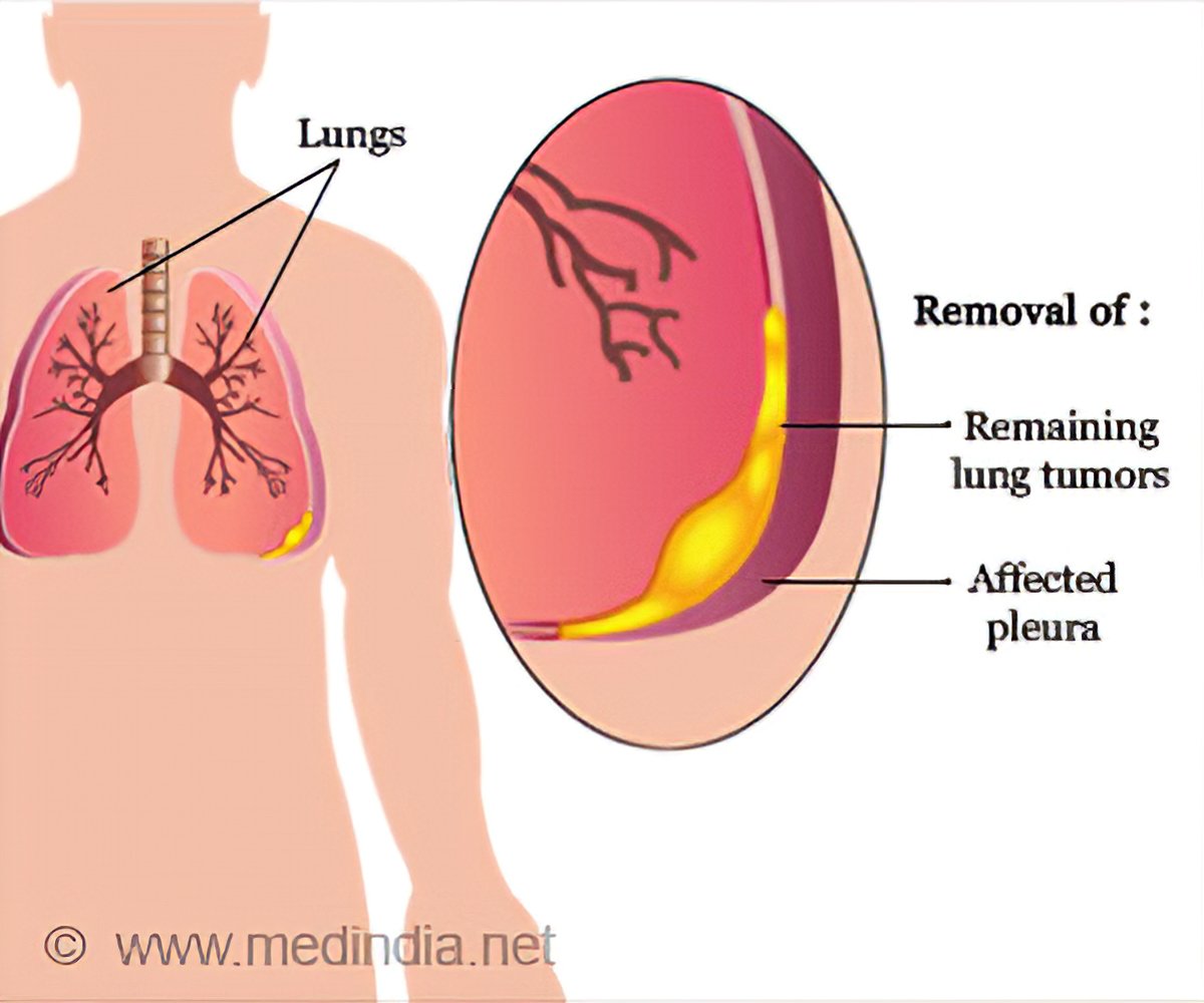 2. Why is P/D Surgery Used to Treat Mesothelioma?
