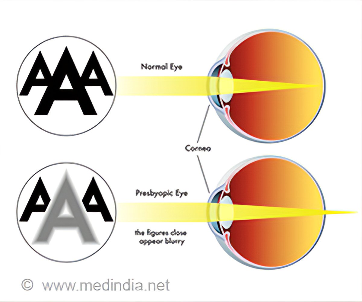 Presbyopia Reduction Chart