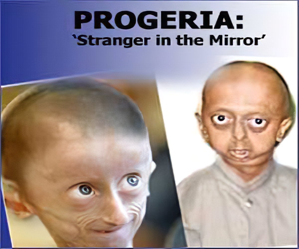 Progeria An Indian Story