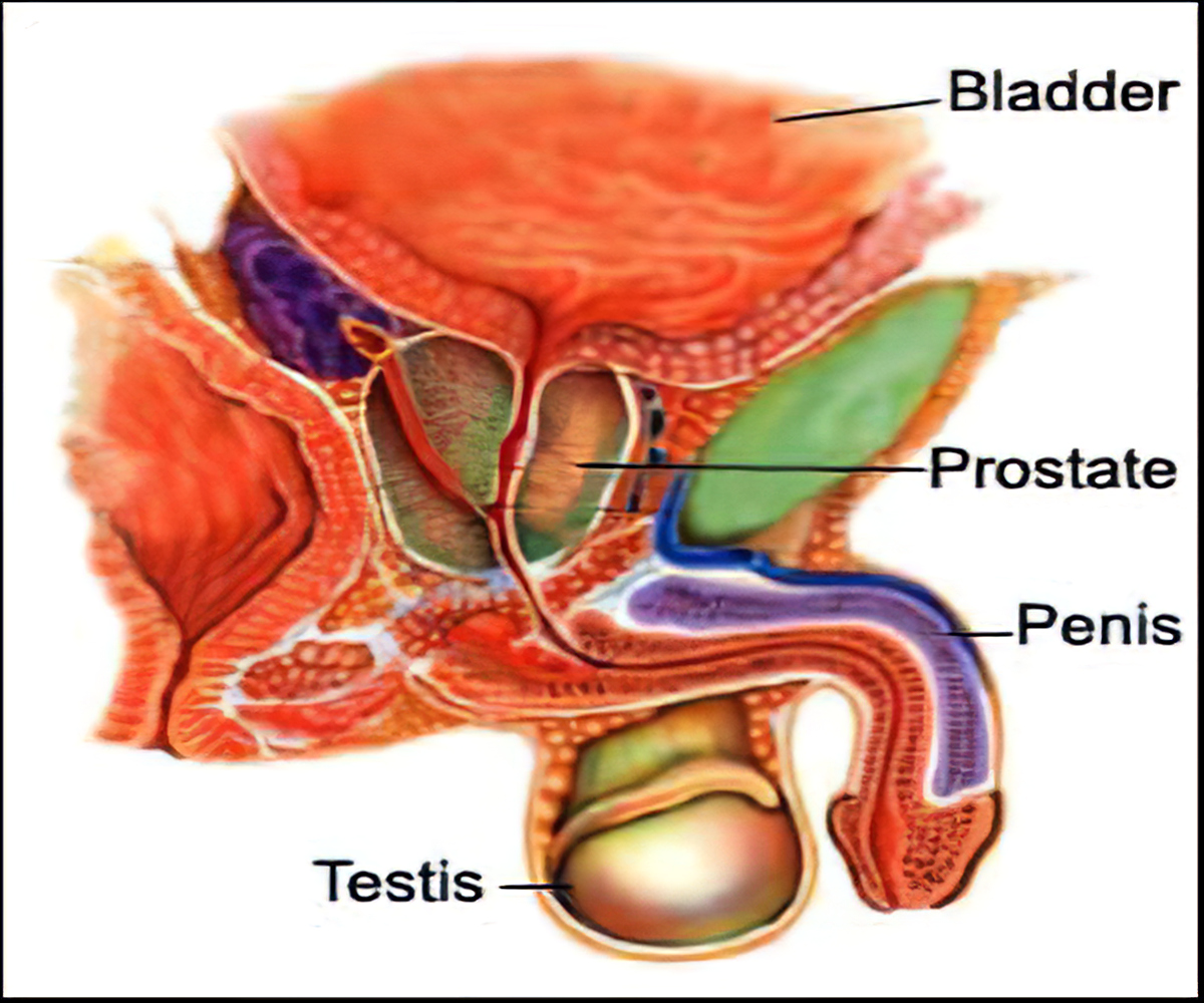 Prostate Cancer: Treatment Options - Surgery, Radiation Therapy, Hormone  Therapy