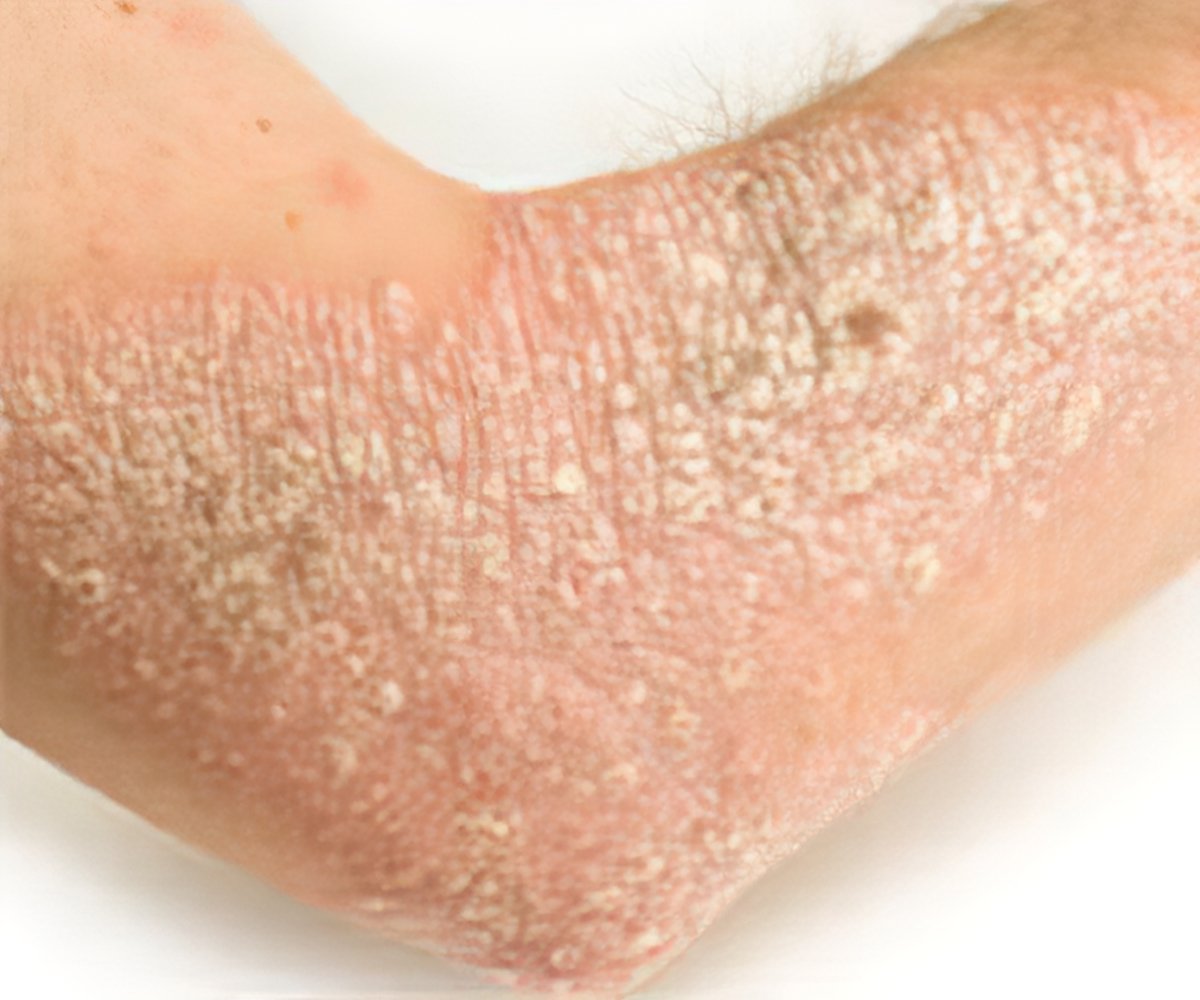 Hives / Urticaria - Symptom Evaluation