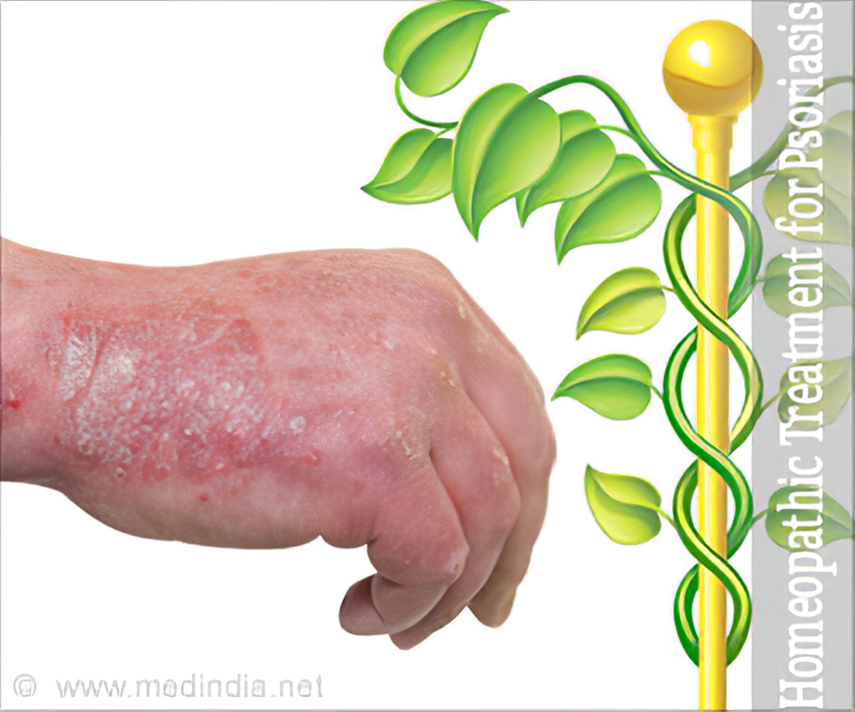 can psoriasis be cured by allopathy)