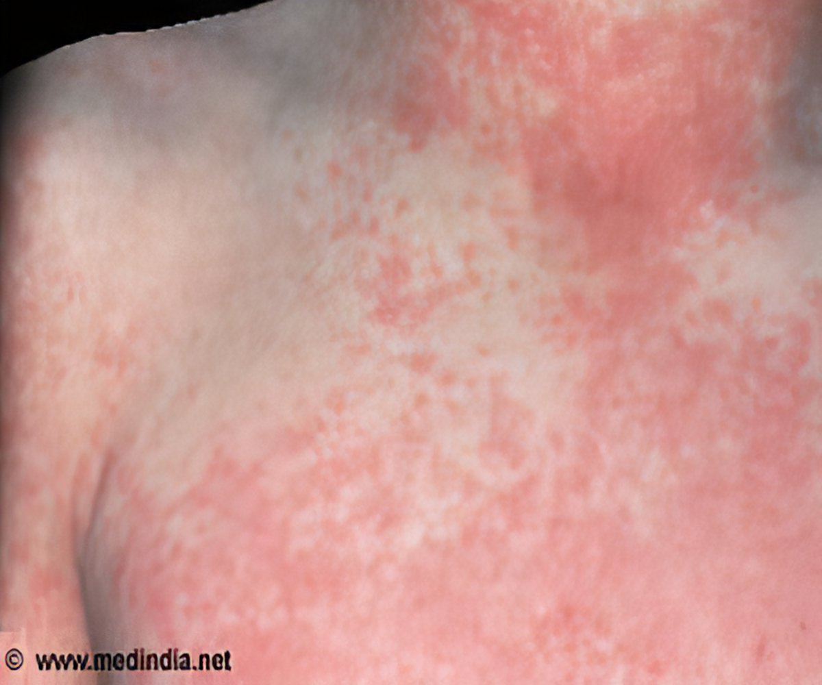 Rheumatic Fever Causes Symptoms Diagnosis Treatment FAQs