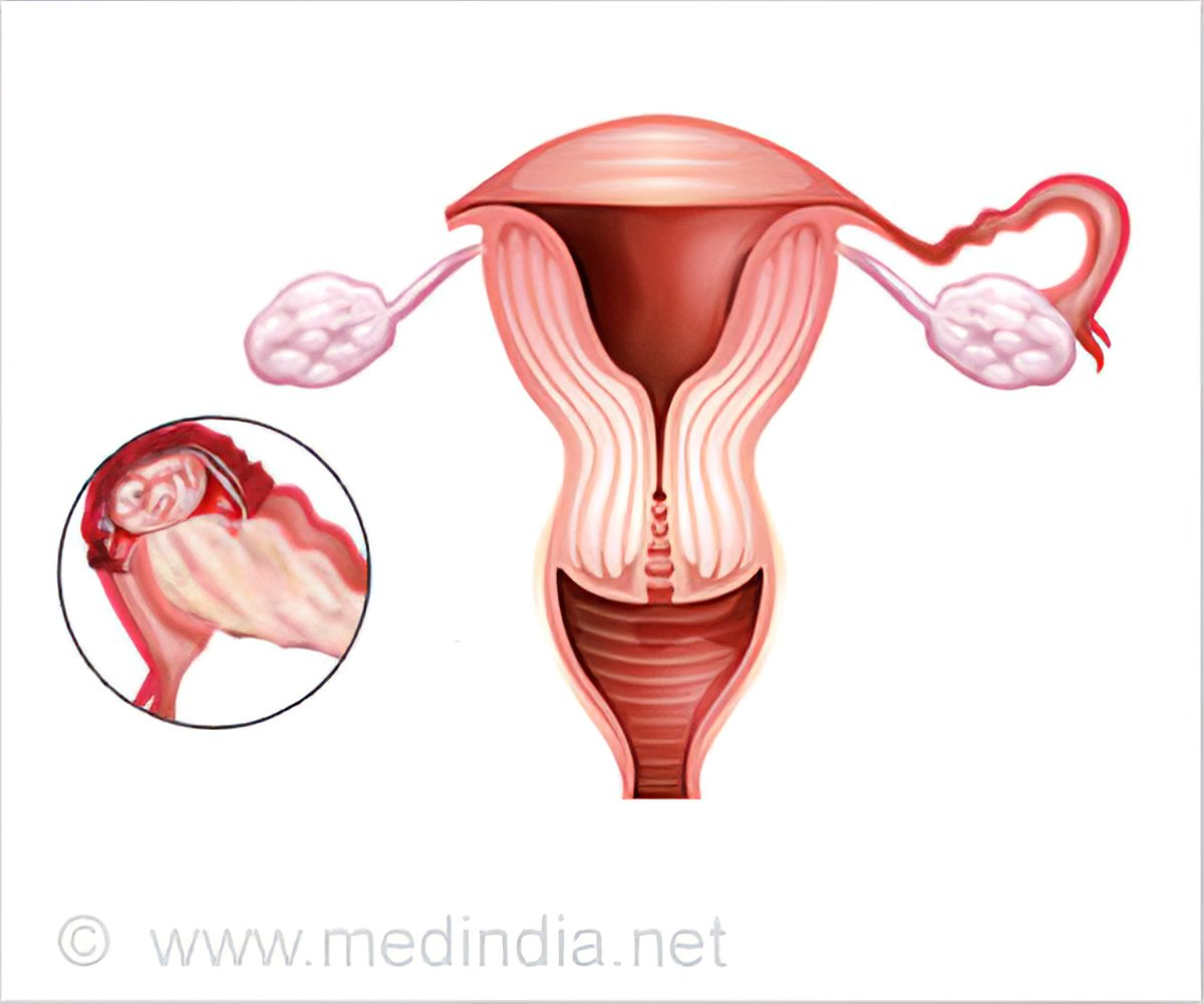 Salpingectomy Types Indications Procedure Complications