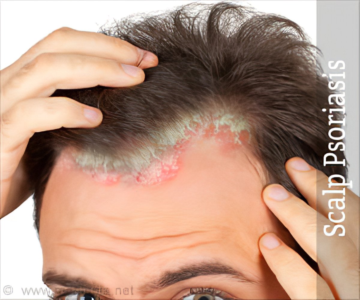 scalp psoriasis causes stress