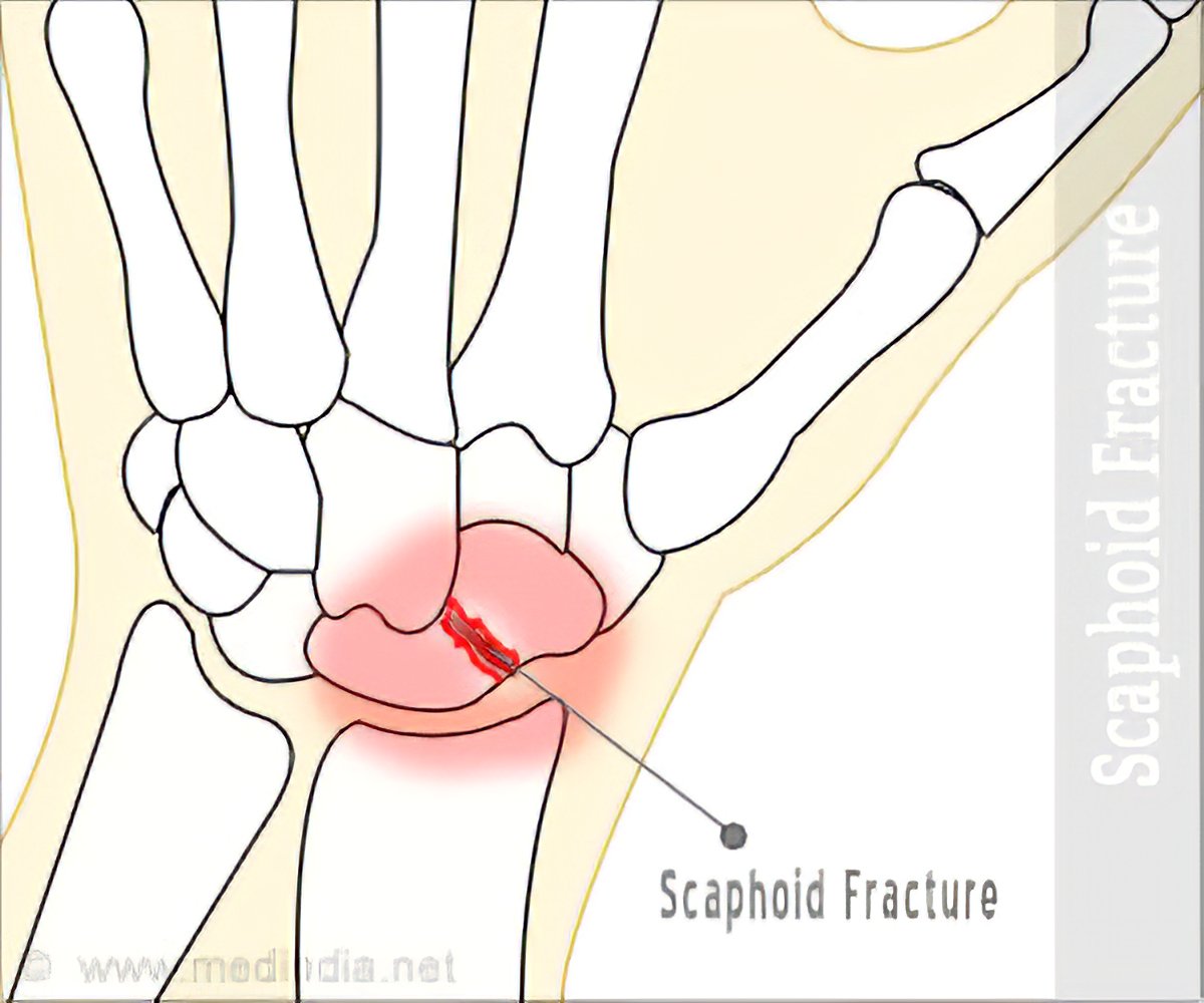 Scaphoid Fracture Of The Wrist Causes Symptoms Diagnosis Treatment