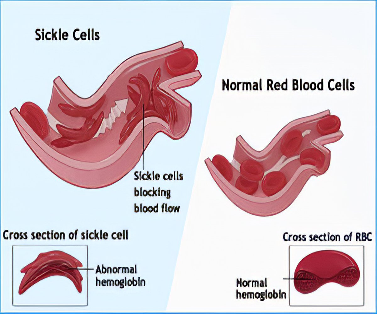 sickle cell anemia symptoms