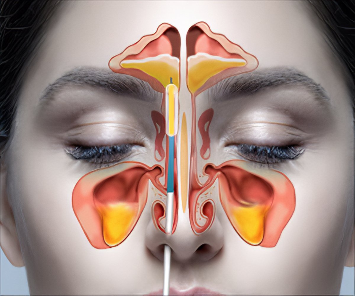 nasal sinus surgery