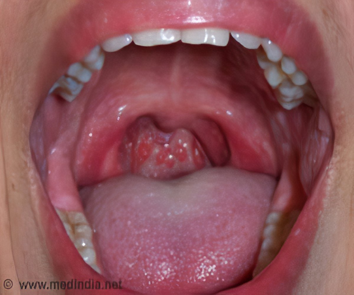 And oral throat sex sore Herpes In