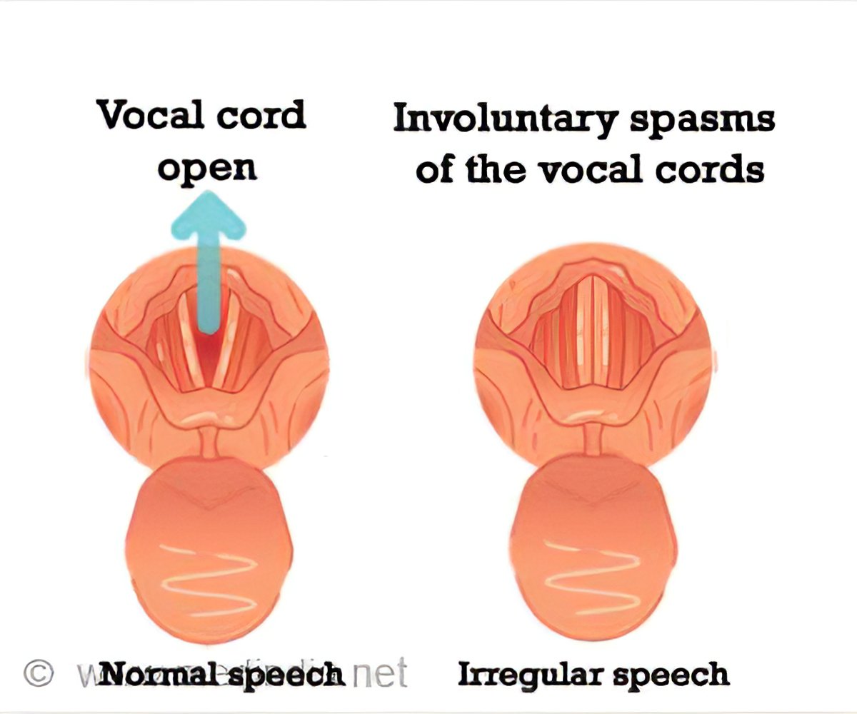 congenital-muscular-torticollis-triumph-therapeutics