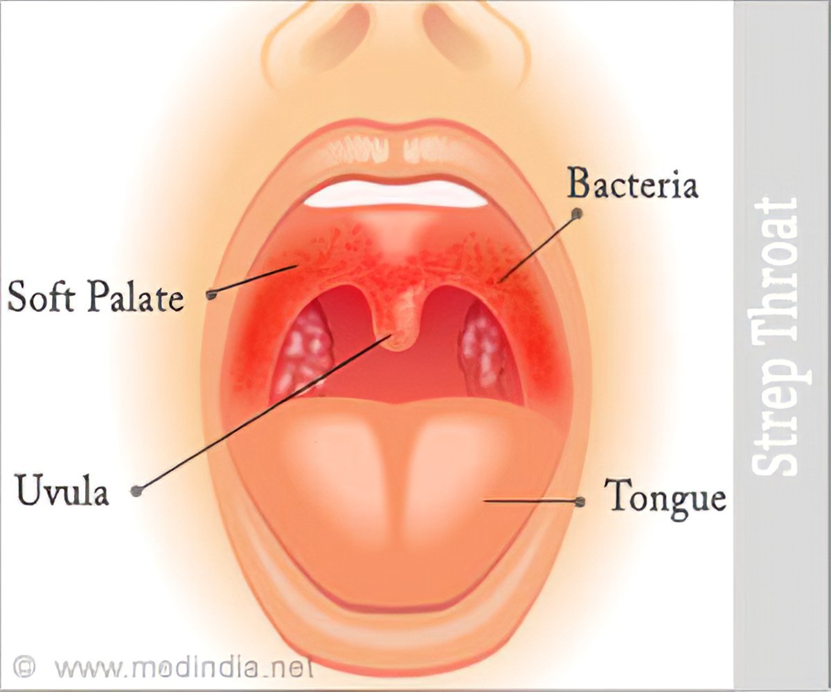 progression-of-strep-throat