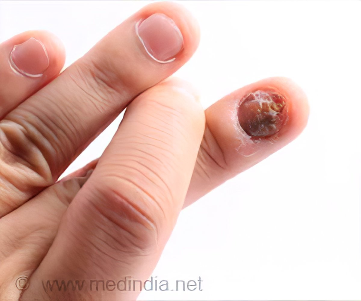 Is Nail Melanoma Always a Stripe or Can It Be a Smudge? » Scary Symptoms