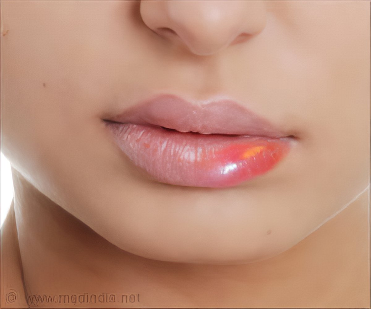 Swollen Lips Lip Edema Symptom Evaluation