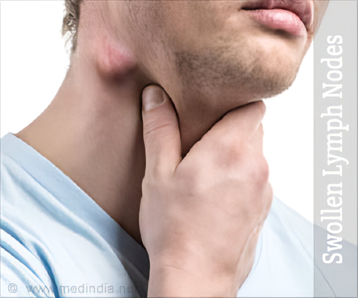 Collection 98+ Pictures photos of swollen lymph nodes in neck Sharp