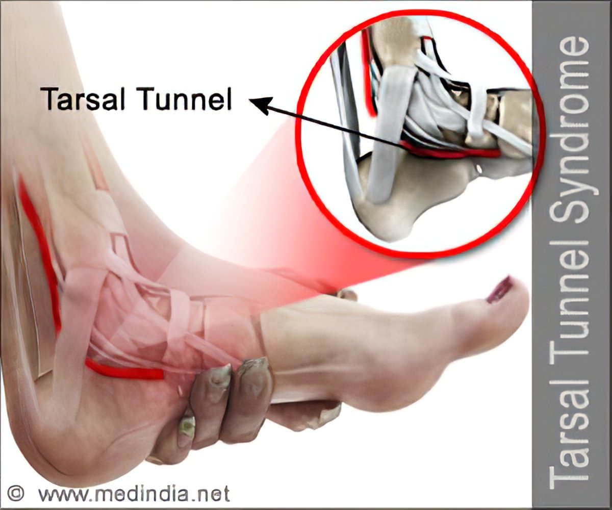 tarsal tunnel syndrome