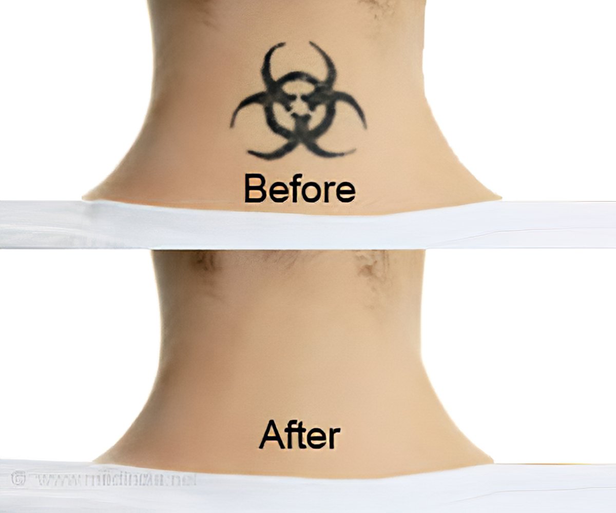 Tattoo Removal Methods - References