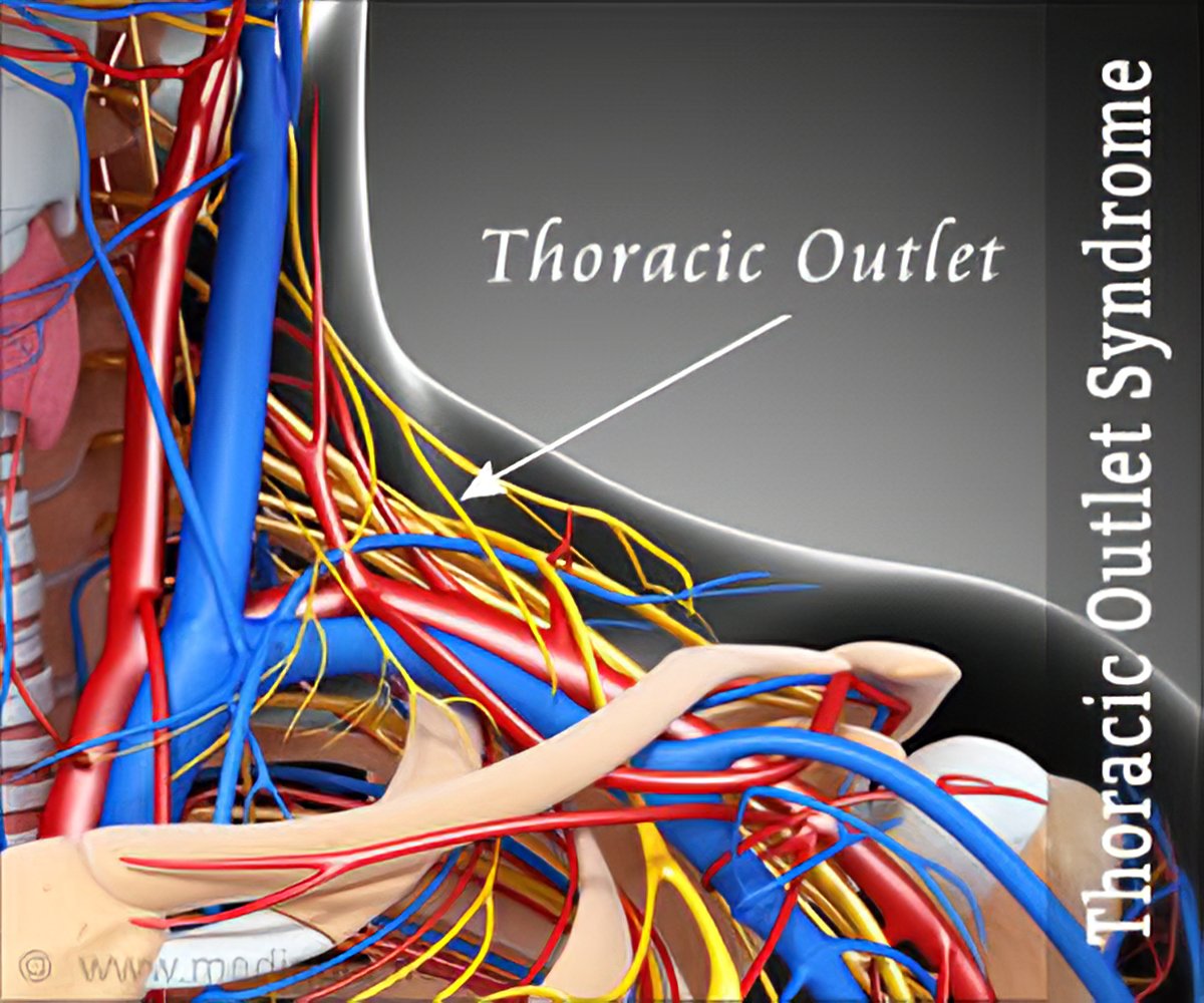 Causes of Venous Thoracic Outlet Syndrome • Thoracic Outlet Syndrome  Testing, Specialists, Symptoms, Exercises