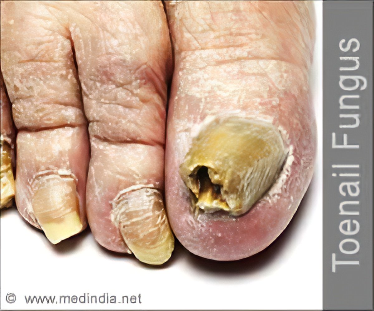 Toenail Fungus - Causes Symptoms Diagnosis Treatment Complications