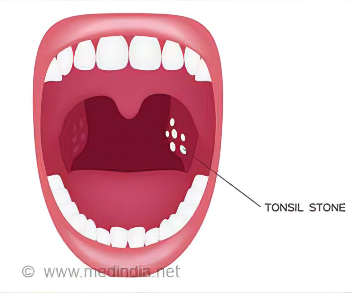 6 home remedies for tonsil stones